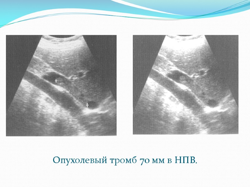 Опухолевый тромб 70 мм в НПВ.
